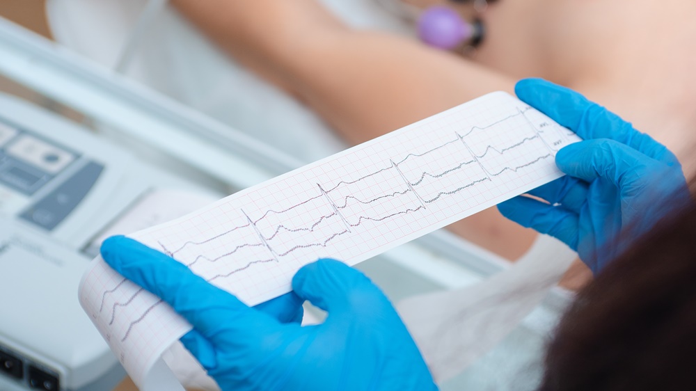 Heart,Cardiogram,In,The,Hands,Of,A,Doctor,Close-up.,Cardiologist